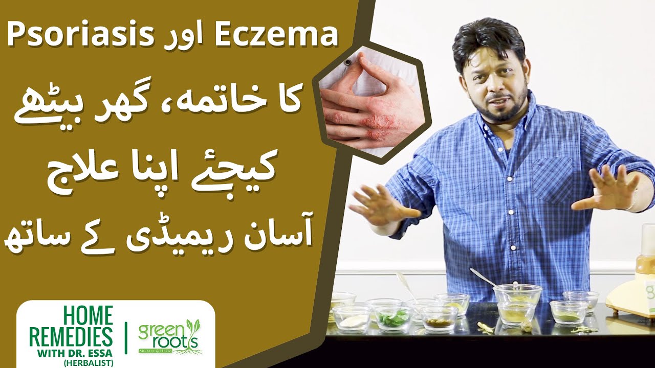 Eczema aur psoriasis ka khatma ghar bethay kijiye ilaj Dr Essa Herbalist ki remedy  | Green Roots