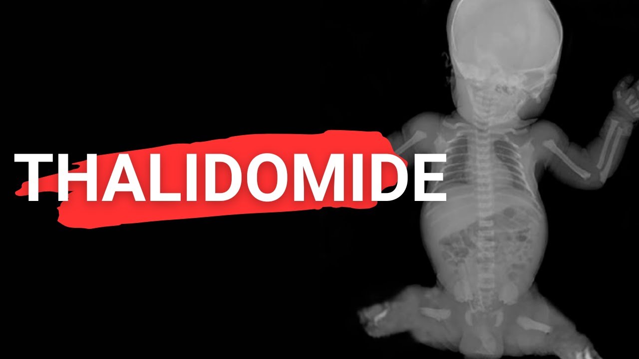 Thalidomide Tragedy: How an Anxiety Pill Maimed 10 000 Children