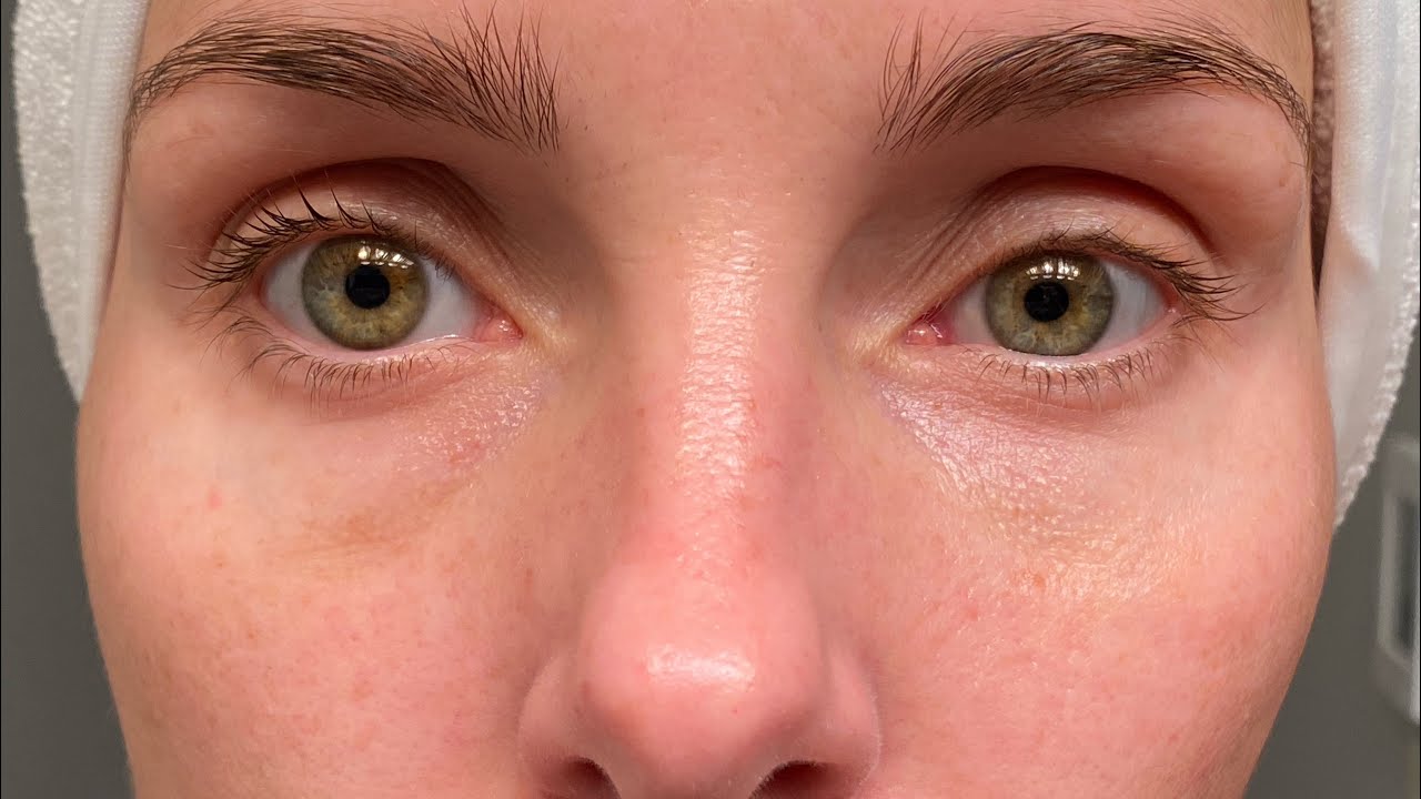 RETIN A 9 MONTH BEFORE & AFTER // TRETINOIN