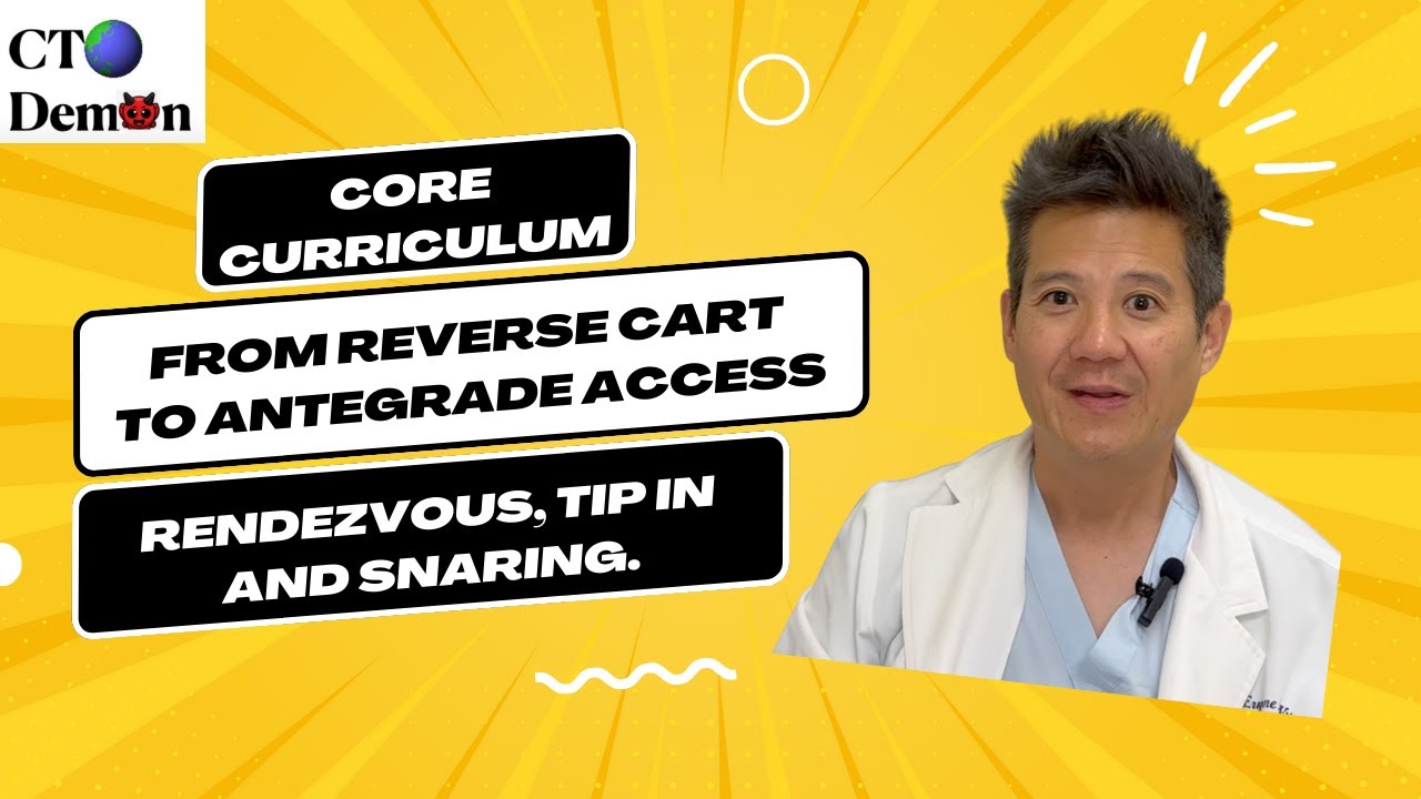 From Reverse CART to Antegrade Wire Access