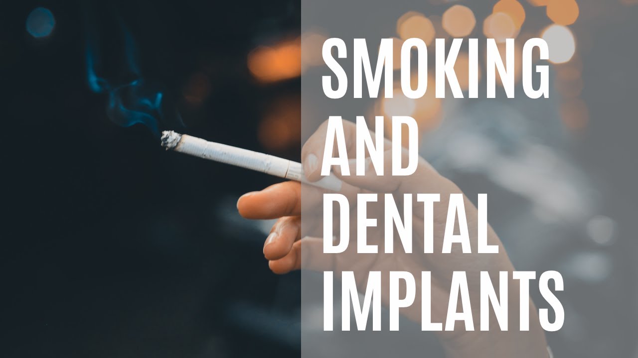 Smoking & dental Implants: What you need to know before having dental implants!
