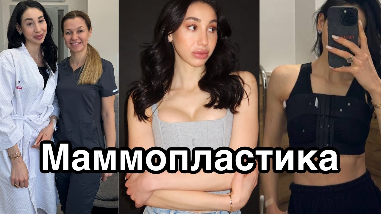 МАММОПЛАСТИКА ЕСТІ:навіщо ЗРОБИЛА ОПЕРАЦІЮ|чи СТРАШНО було|як пройшла РЕАБІЛІТАЦІЯ|питання/відповідь