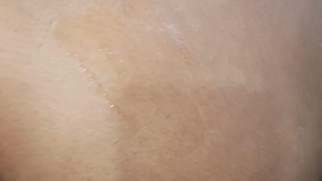 Im injection