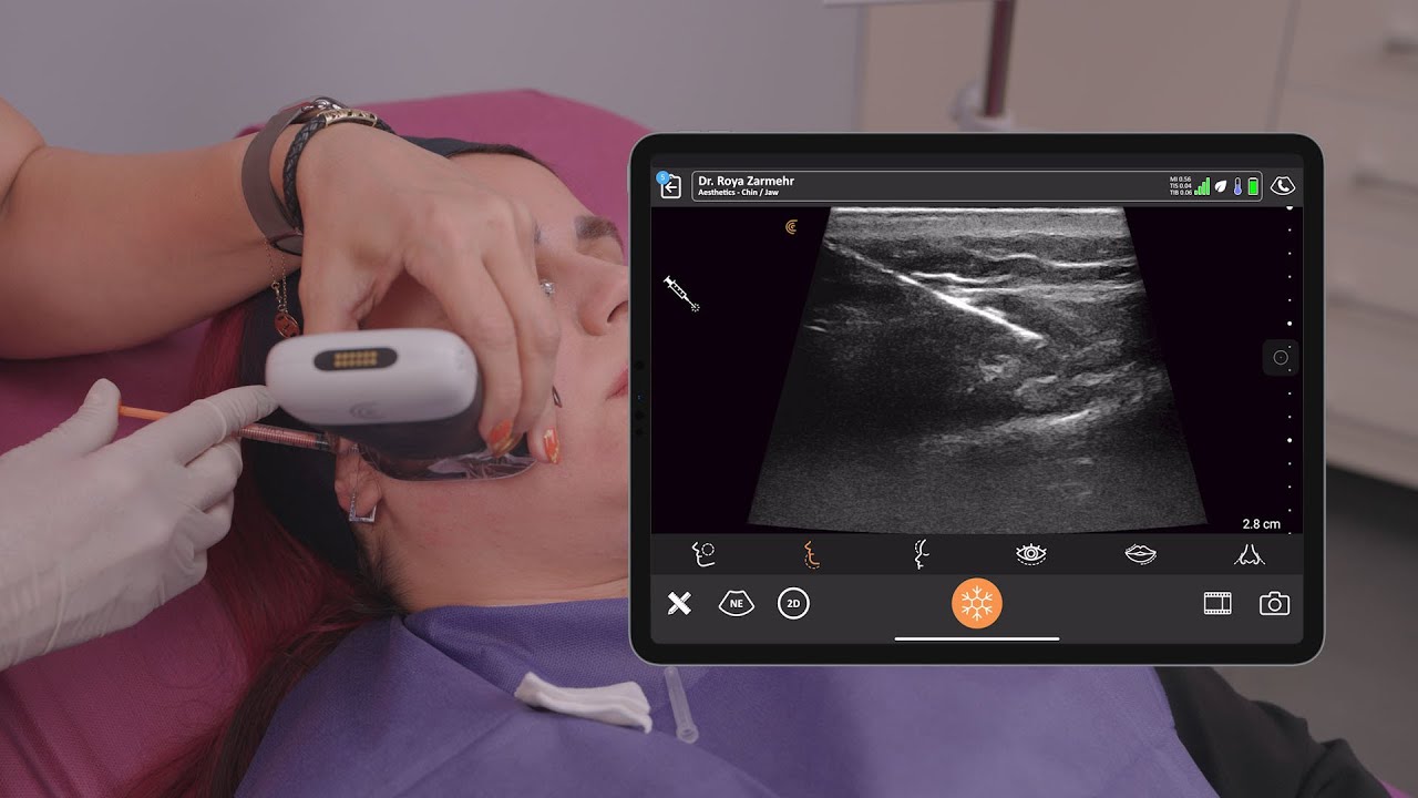 ФАКТ: Инъекция в жевательную мышцу [Оценка лица с помощью технологии Clarius]