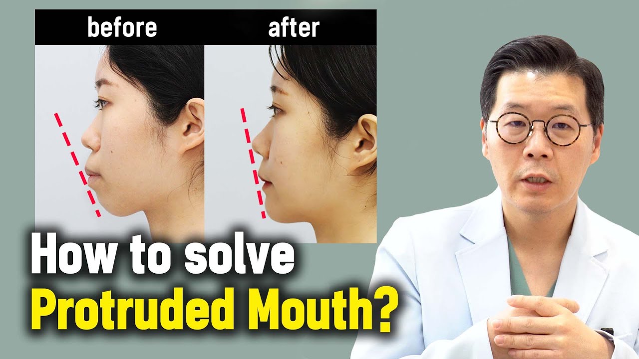 [EN/JP] How to solve Protruded Mouth l Korean Protruded Mouth surgery case review