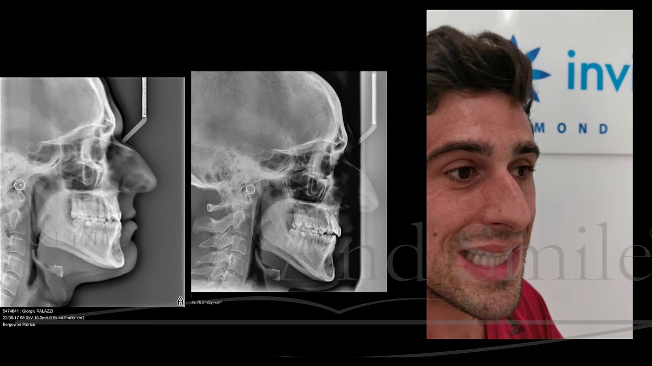 Chirurgie  Orthognatique ou compensation dentoalvéolaire avec 2lastiques et Invisalign.