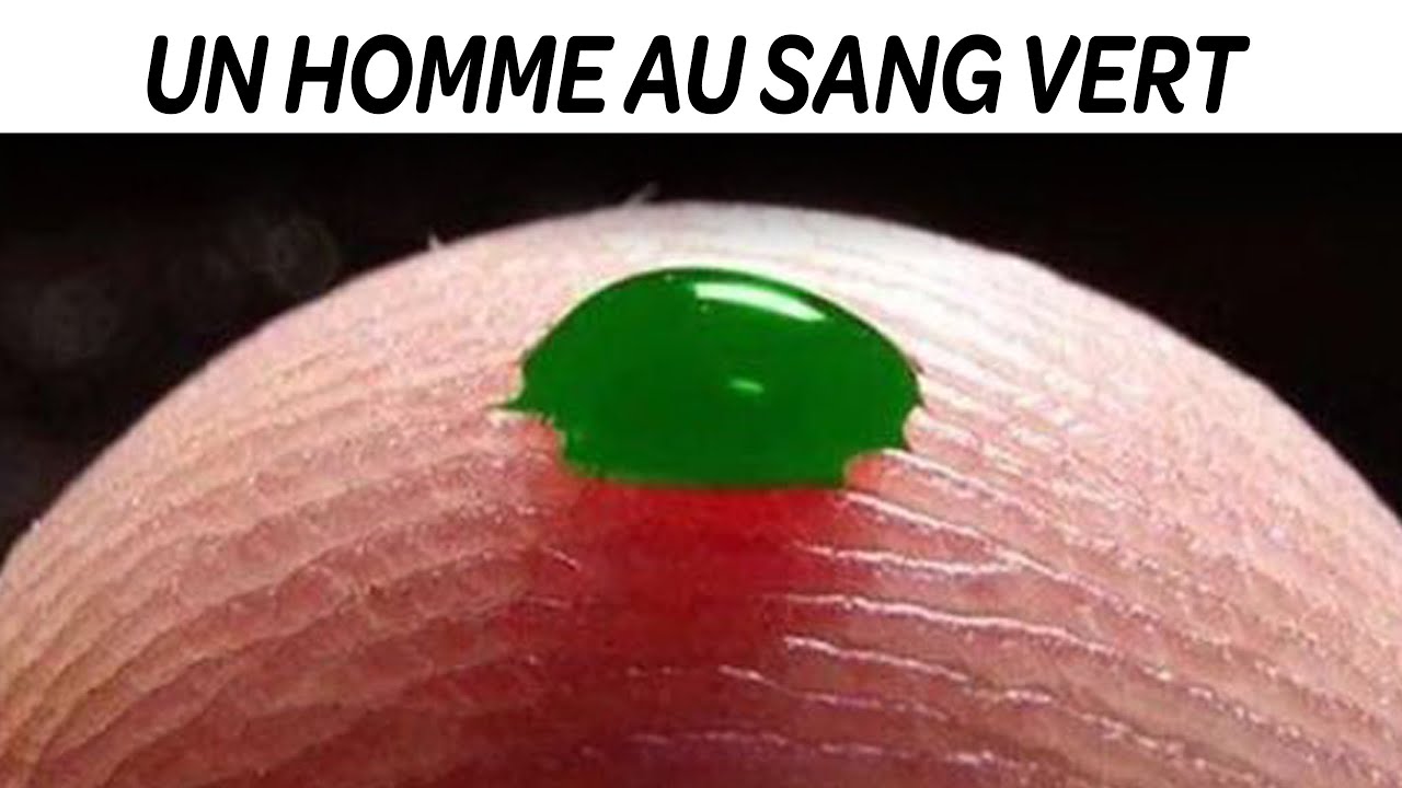 7 Maladies Rares Qui Existent Vraiment.