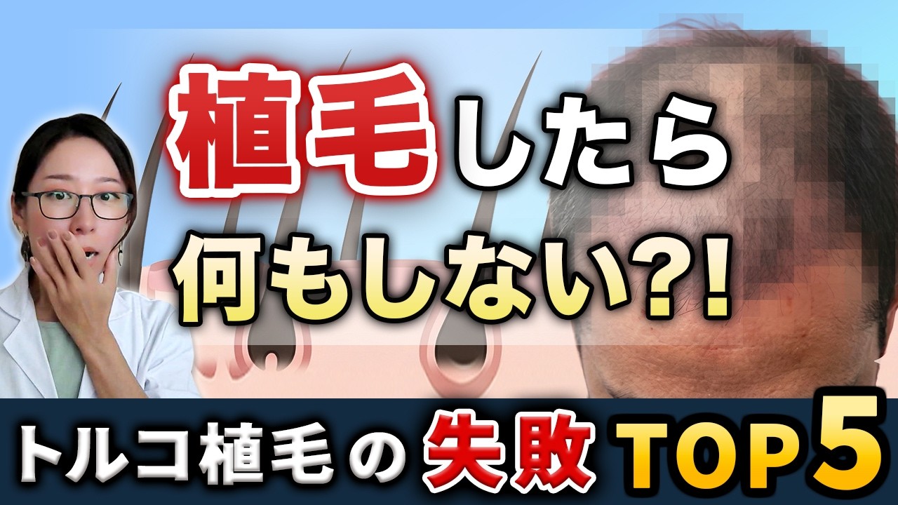 【9割が勘違い】植毛すれば完治すると思っていませんか？【トルコ植毛の失敗TOP5】