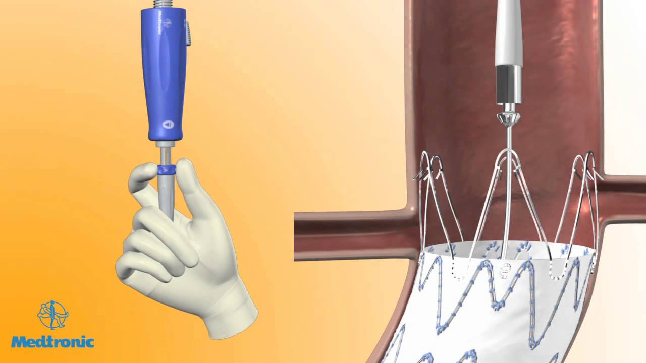 Endurant Deployment Animation