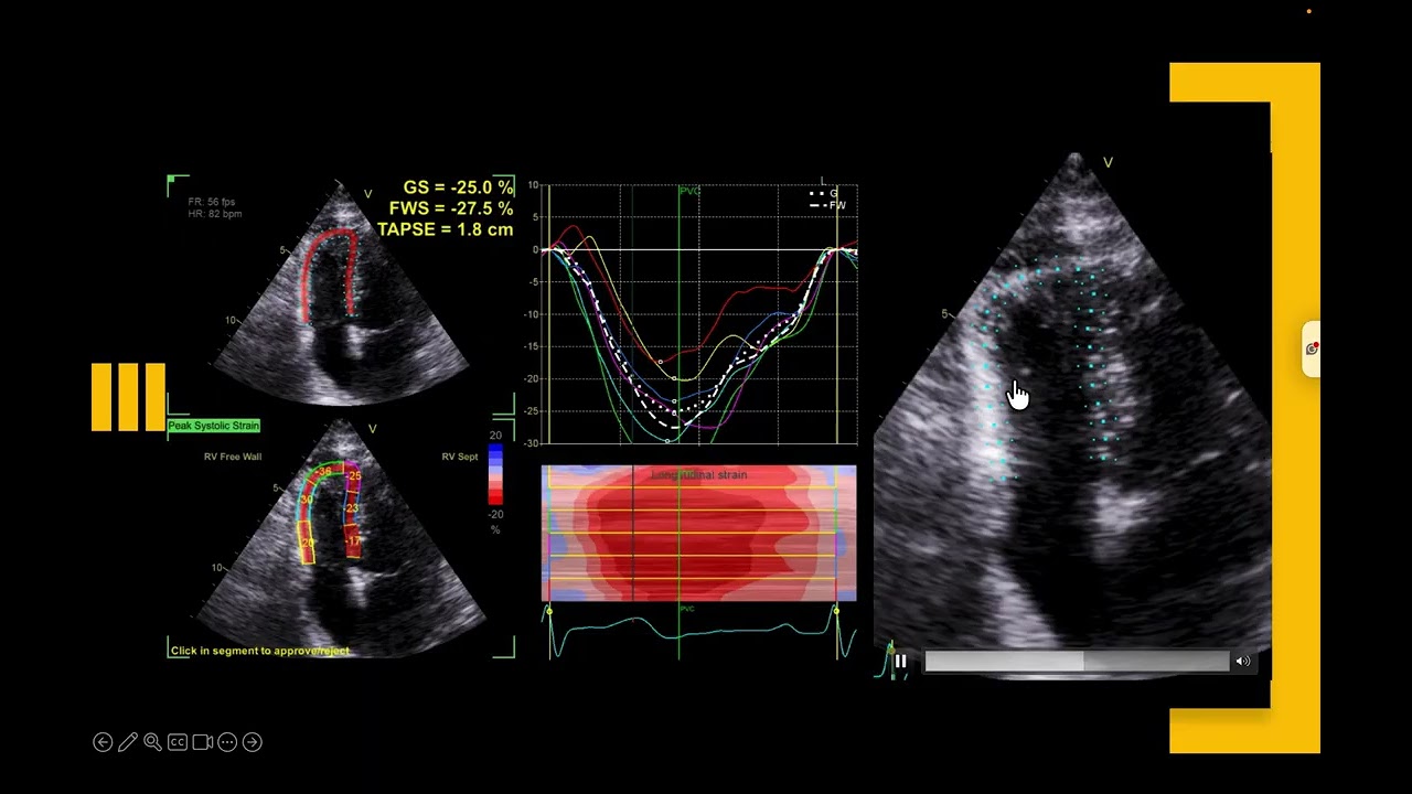 RV Strain Simplified: Views, ROI & Variability Explained. Why Your Numbers May Not Be Right🫀⚠️