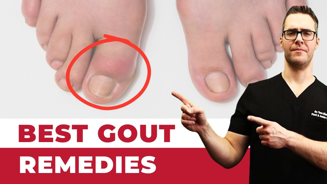 🔥Czym jest dna moczanowa? PRAWDZIWE przyczyny i metody leczenia! [Objawy, dieta i diagnoza]