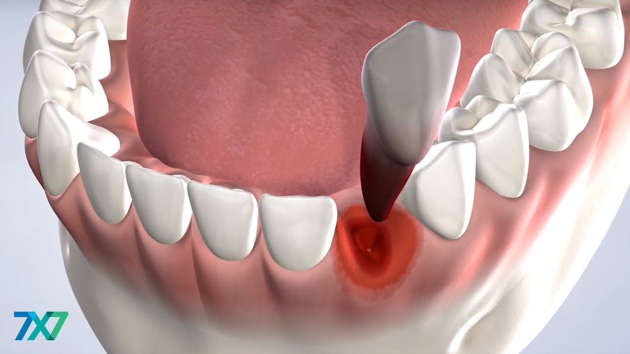 Tooth Extraction in San Francisco, CA | 7x7 Dental Implant & Oral Surgery Specialists