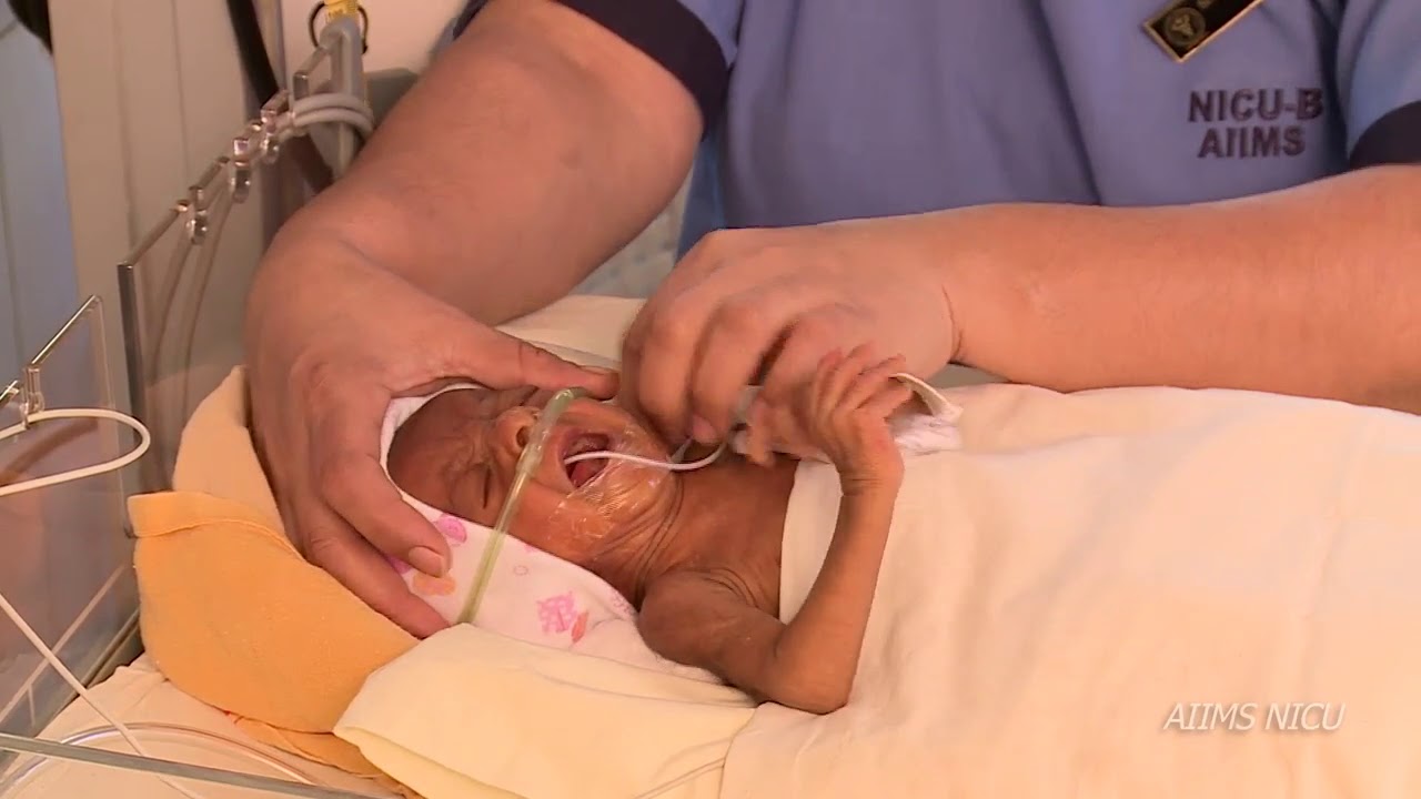 How to fix Ram cannula interface  for a newborn baby?