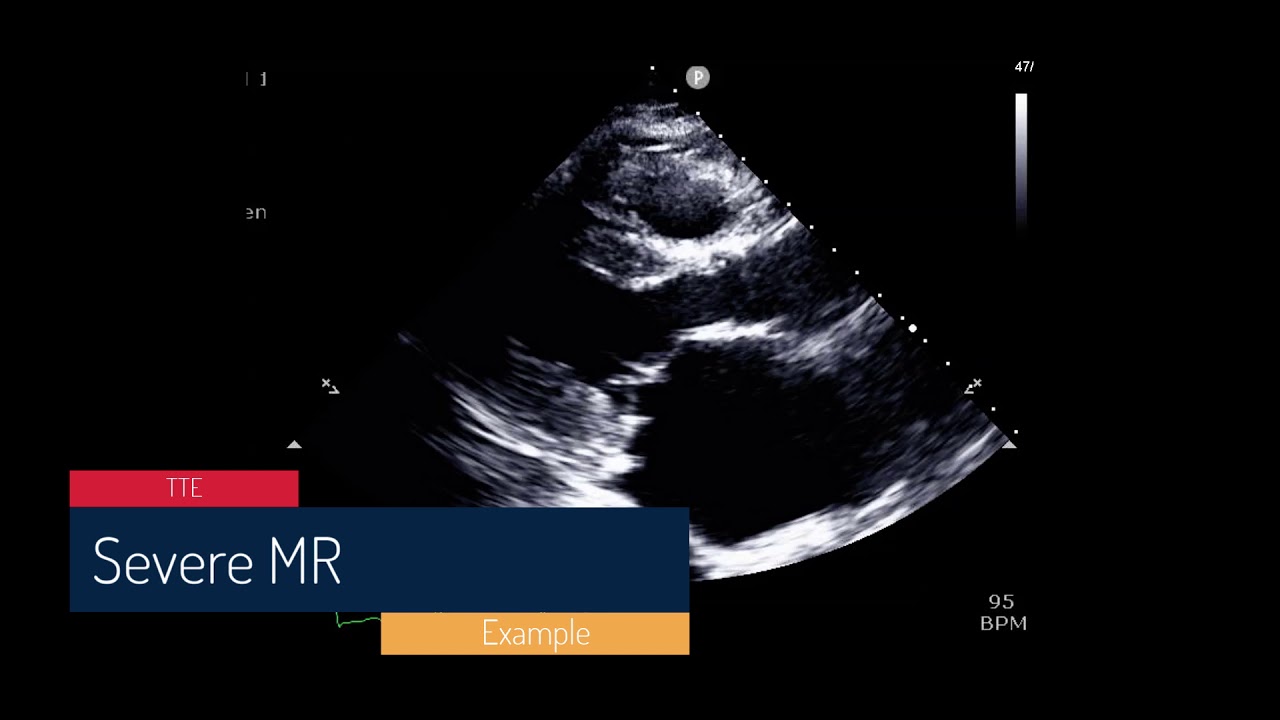 Mitral valve ERO