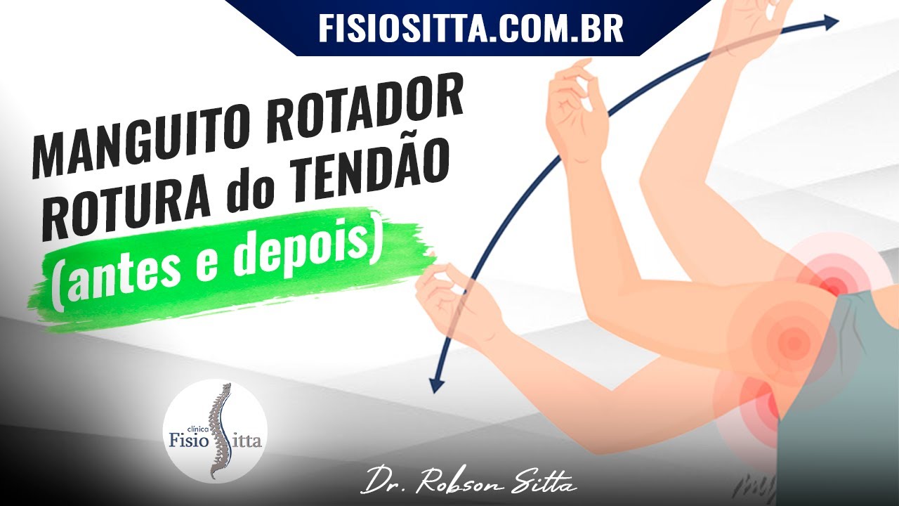MANGUITO ROTADOR do OMBRO ROTURA do TENDÃO PÓS OPERATÓRIO Clínica de Fisioterapia Dr. Robson Sitta