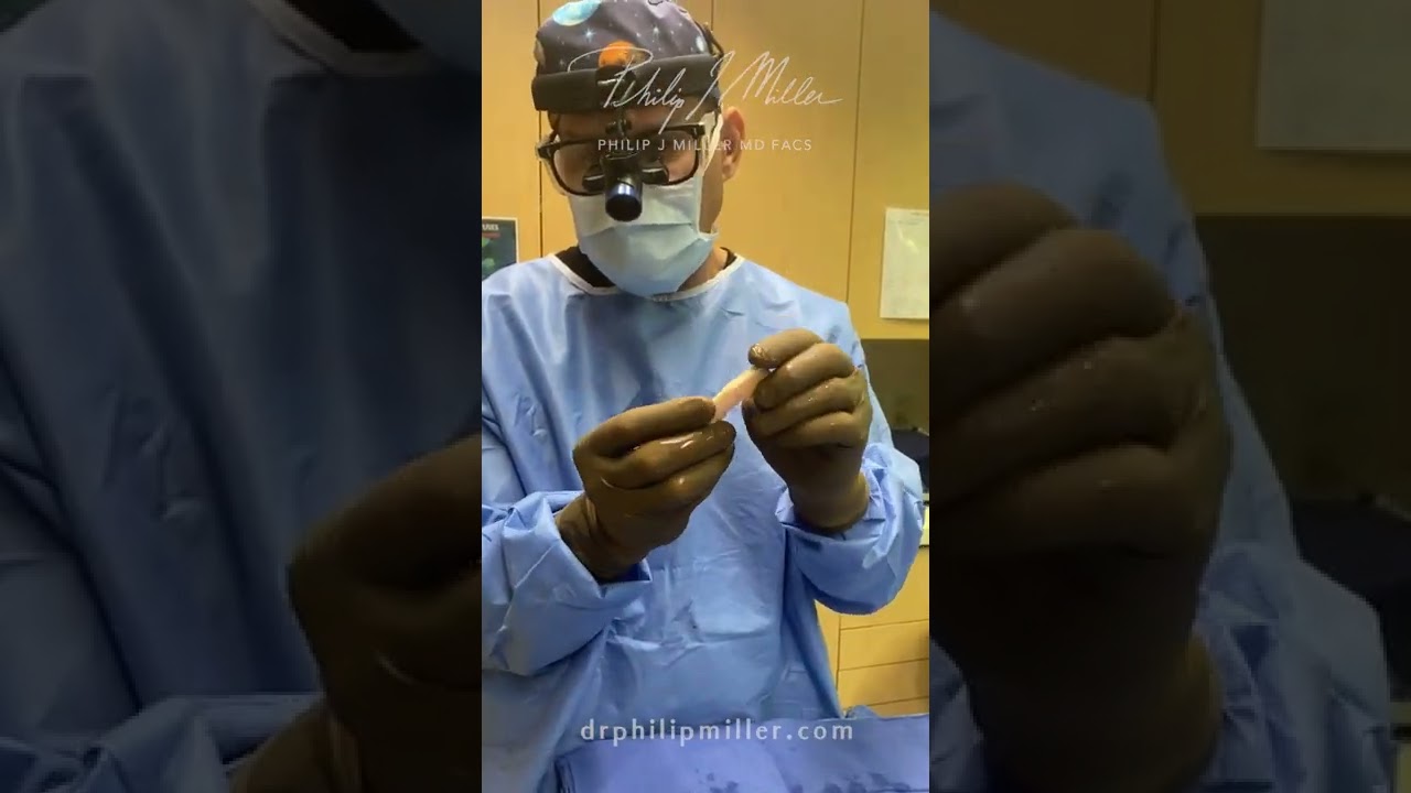 What Type Of Cartilage Graft Is Ideal For Rhinoplasty?