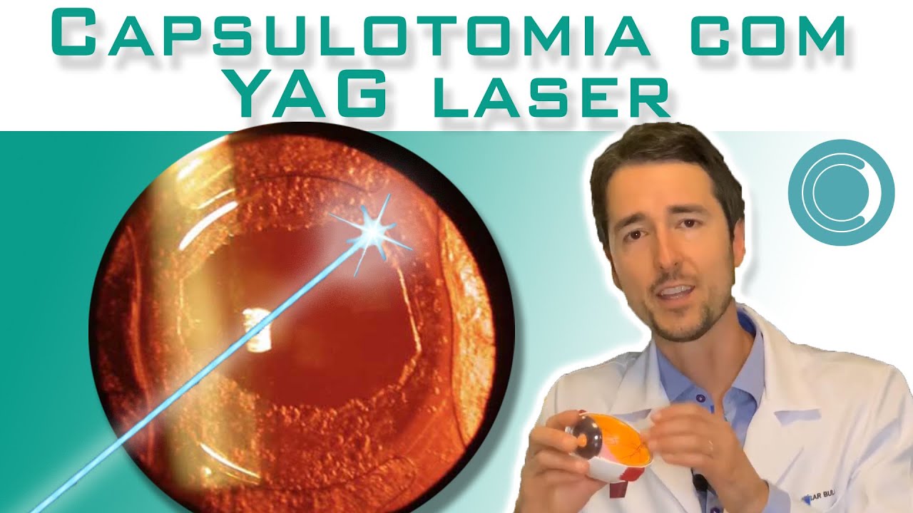 Capsulotomia com YAG laser - Limpeza da lente intraocular.