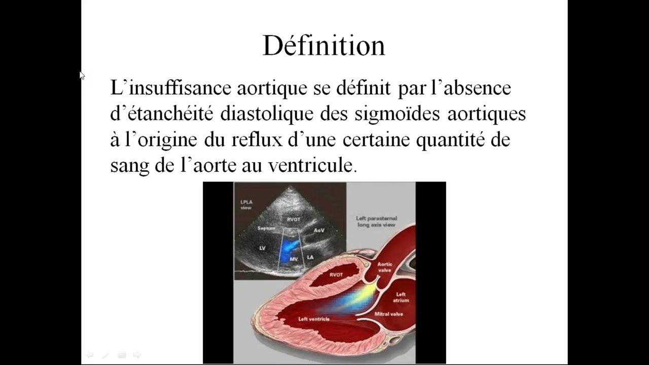 Insuffisance aortique 🤩 explication la plus claire 🤩 Pr  H  ZOUZOU #ECN