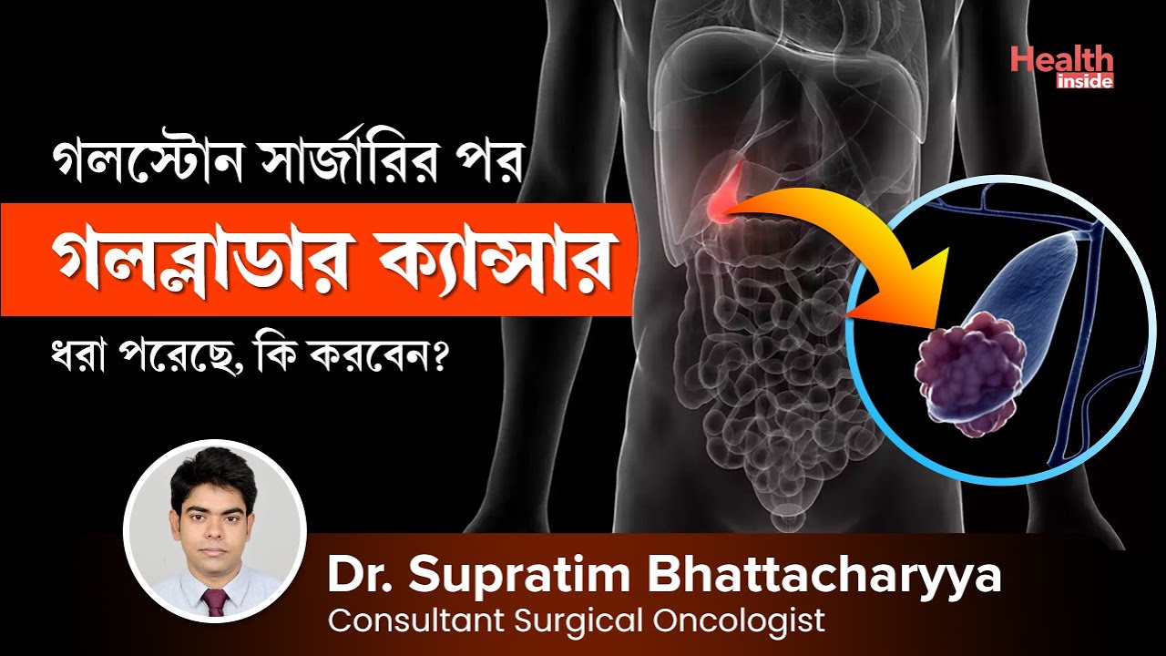 গলস্টোন সার্জারির পর গলব্লাডার ক্যান্সার হলে চিকিৎসা কি | Gallbladder Cancer after Gallstone Surgery