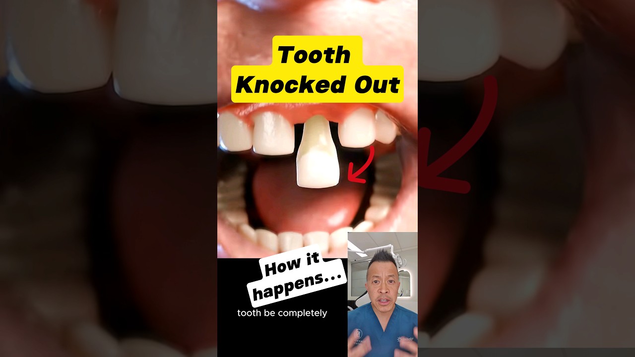 Losing a Tooth: The Science Behind Knocked-Out Teeth #dentallan #dentist #shorts