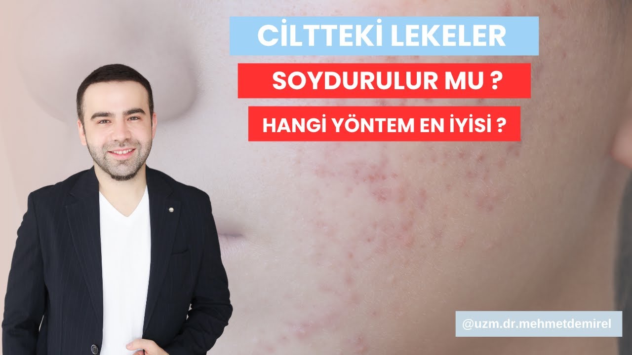 CİLTTEKİ LEKELER SOYDURULUR MU ? HANGİ YÖNTEM EN İYİSİ ?