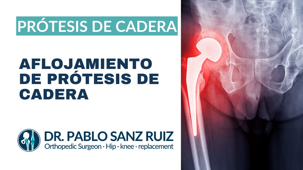 Aflojamiento de Pr&oacute;tesis de Cadera: Causas y Tratamientos - Dr. Pablo Sanz Ruiz