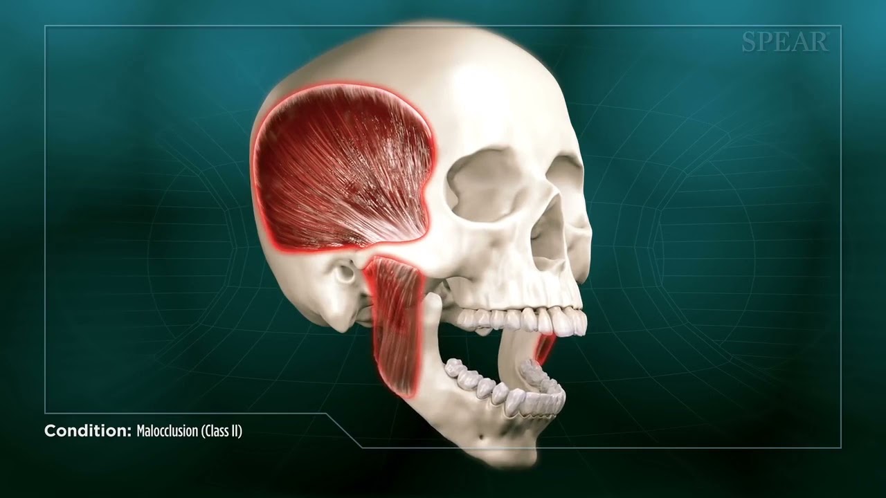 Malocclusion (Class II)