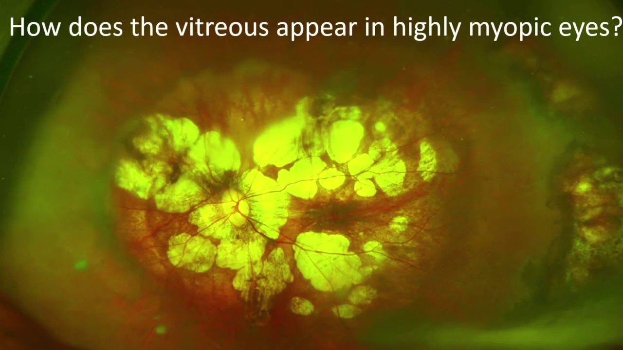 RET14 03   Section X Imaging   Ultrawide field Swept Source OCT for Dynamic Observations of Vitreous