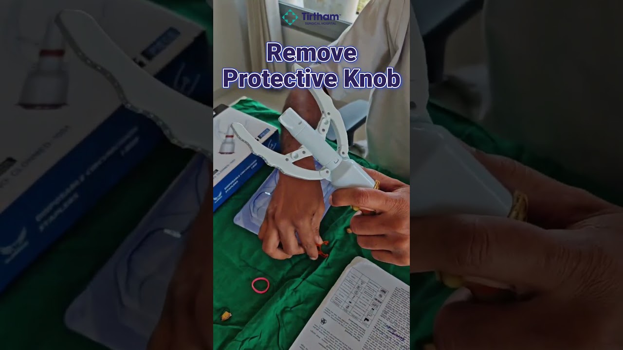 Stapler Circumcision Operation Demonstration #circumcisionsurgery #sunnat #foreskin