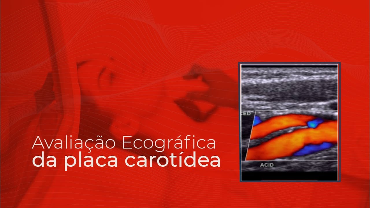 Avalia&ccedil;&atilde;o Ecogr&aacute;fica da placa carot&iacute;dea