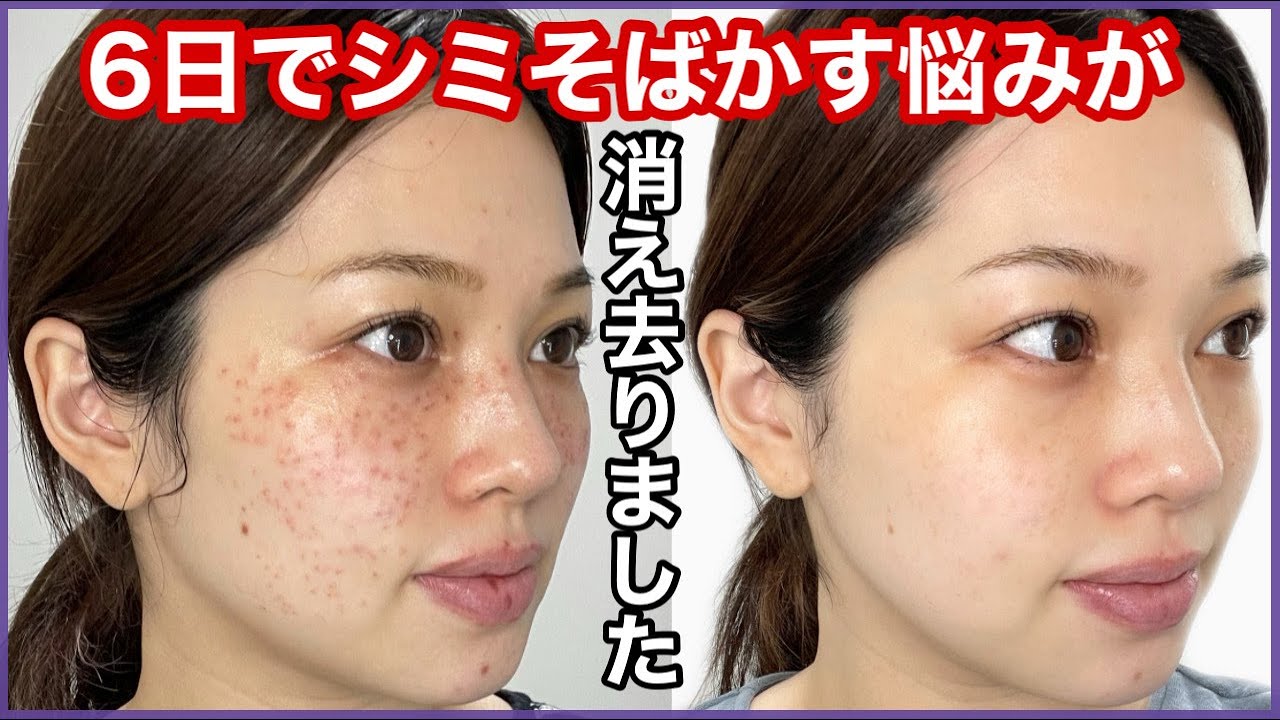 【報告】シミそばかすが６日で消えた💉クリニックやダウンタイム経過も公開します‼️【ピコスポット】
