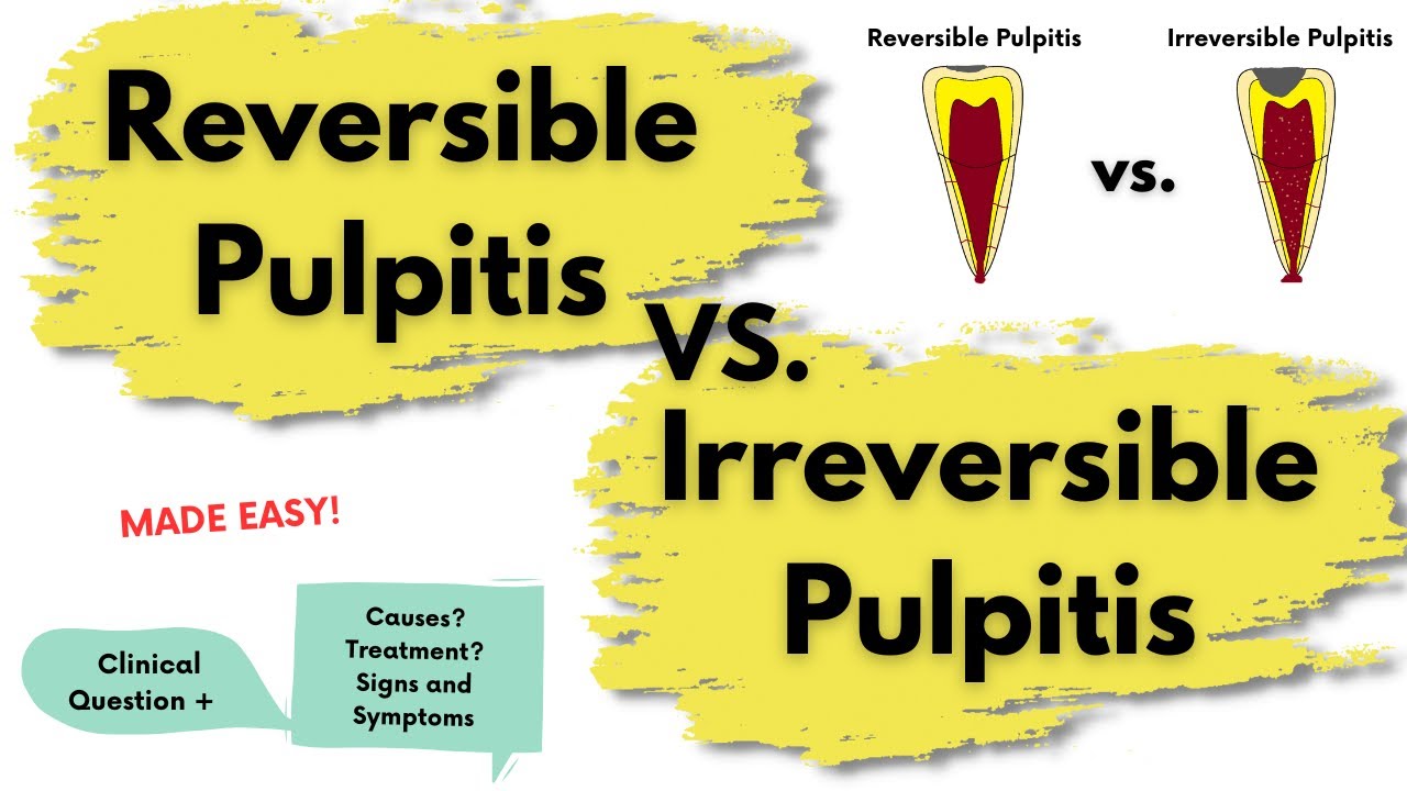 Reversible Pulpitis vs. Irreversible Pulpitis | Endodontics