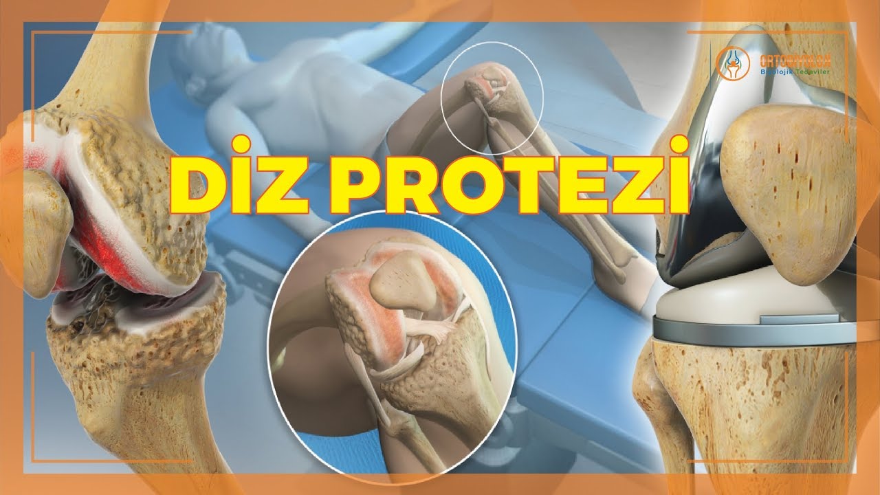 DİZ PROTEZİ HAKKINDA SIK SORULAN SORULAR
