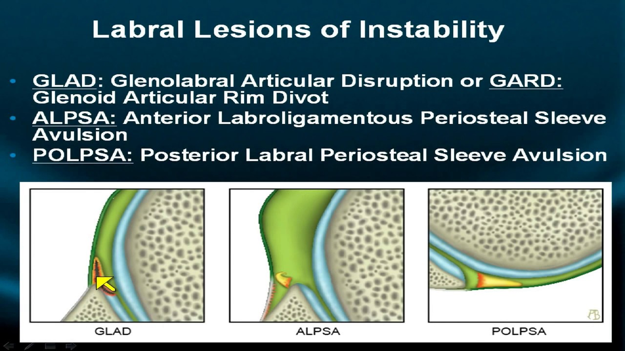 Shoulder MRI: Instability, Part IV