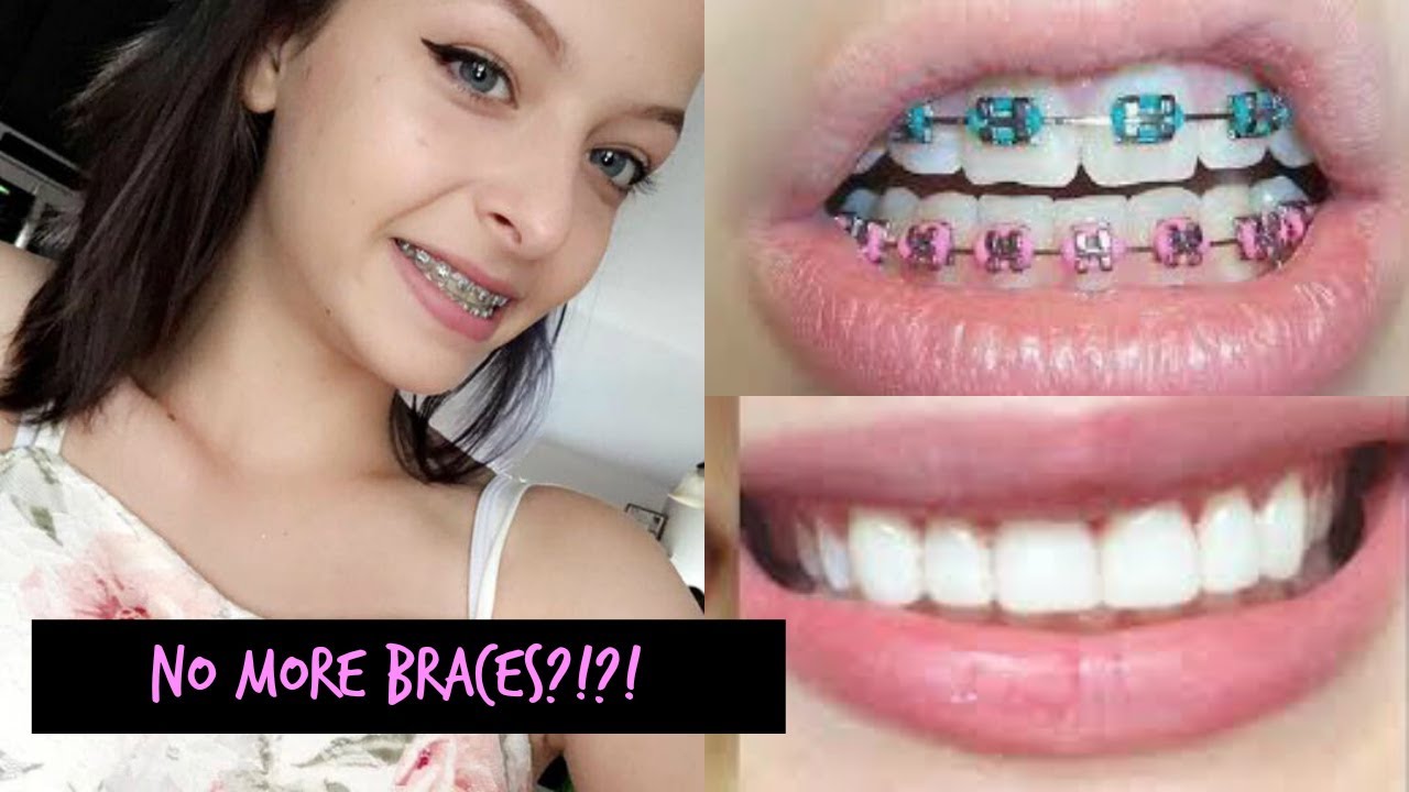 Getting My Braces Off!! Vlog