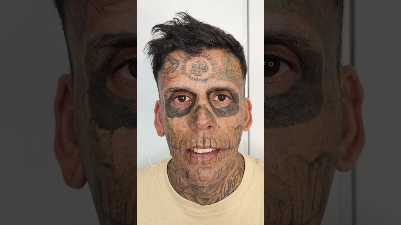 Resultado da 3&ordm; sess&atilde;o com o Leandro  | Remo&ccedil;&atilde;o de Tatuagem