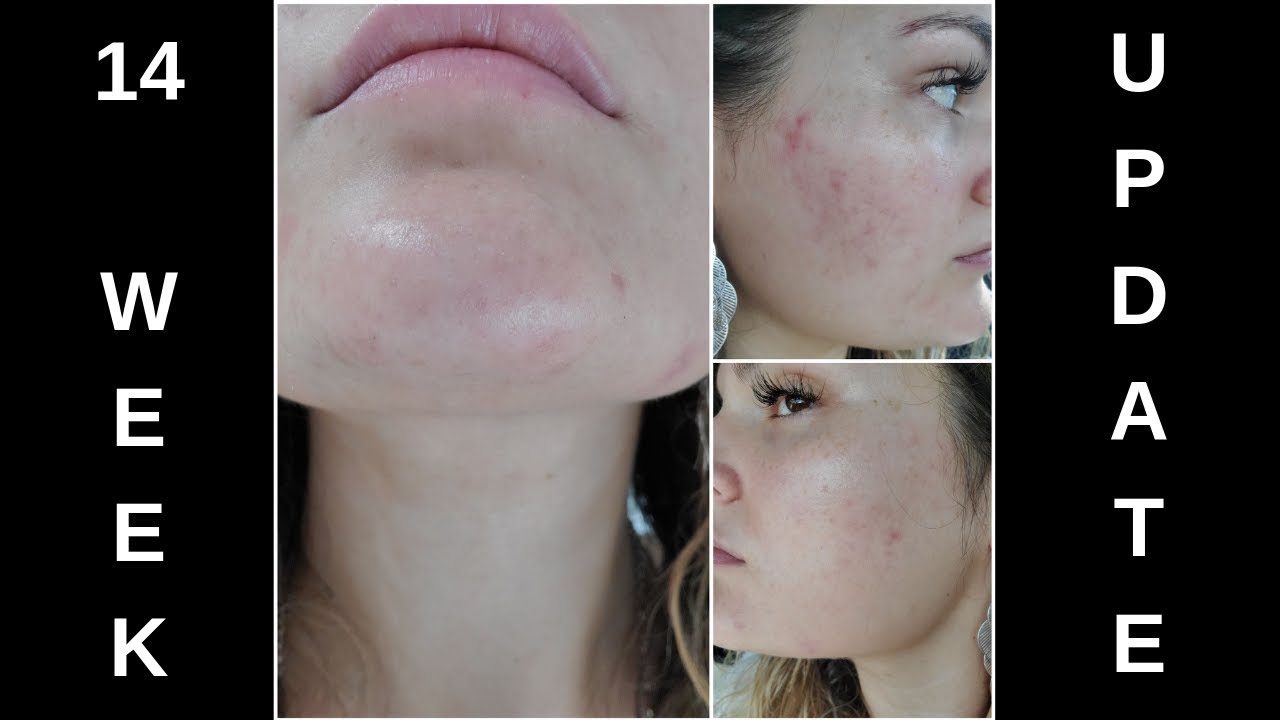 Spironolactone for Acne! 14 WEEK UPDATE! (+ Altreno update!) - Episode #12