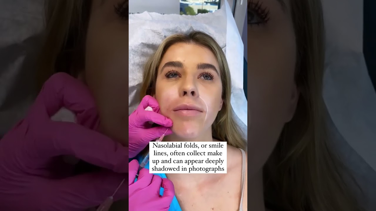 NASOLABIAL FOLDS! 🥰❤️ #FILLER