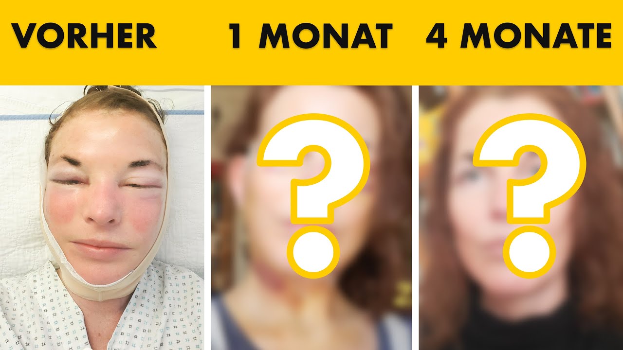 Face- & Halslift Heilungsverlauf TAG FÜR TAG dokumentiert! | Dr. Jungwirth - Plastische Chirurgie