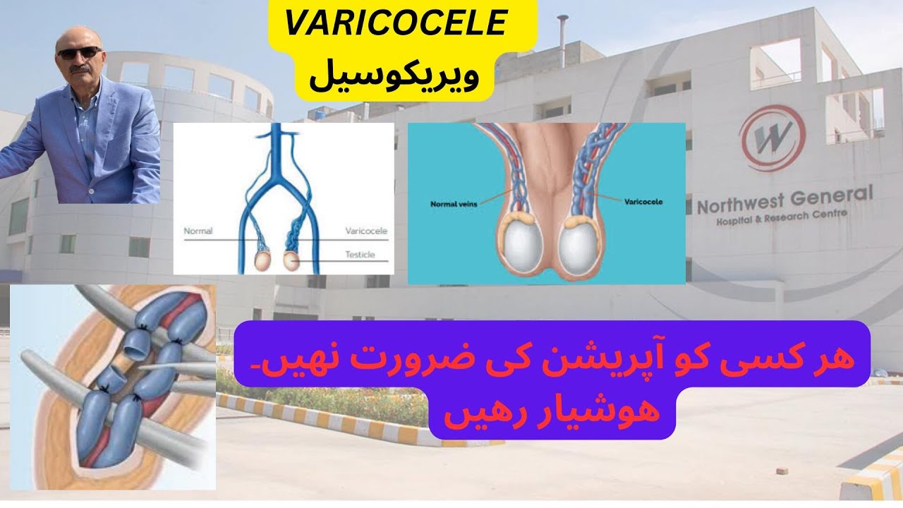 VARICOCELE . ویریکوسیل, ھر کسی کو آپریشن کی ضرورت نھیں۔ ھوشیار رھیں