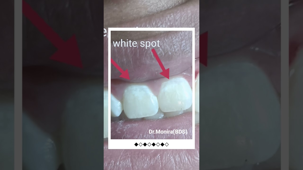 Dental fluorosis due to excessive intake of fluoride. 