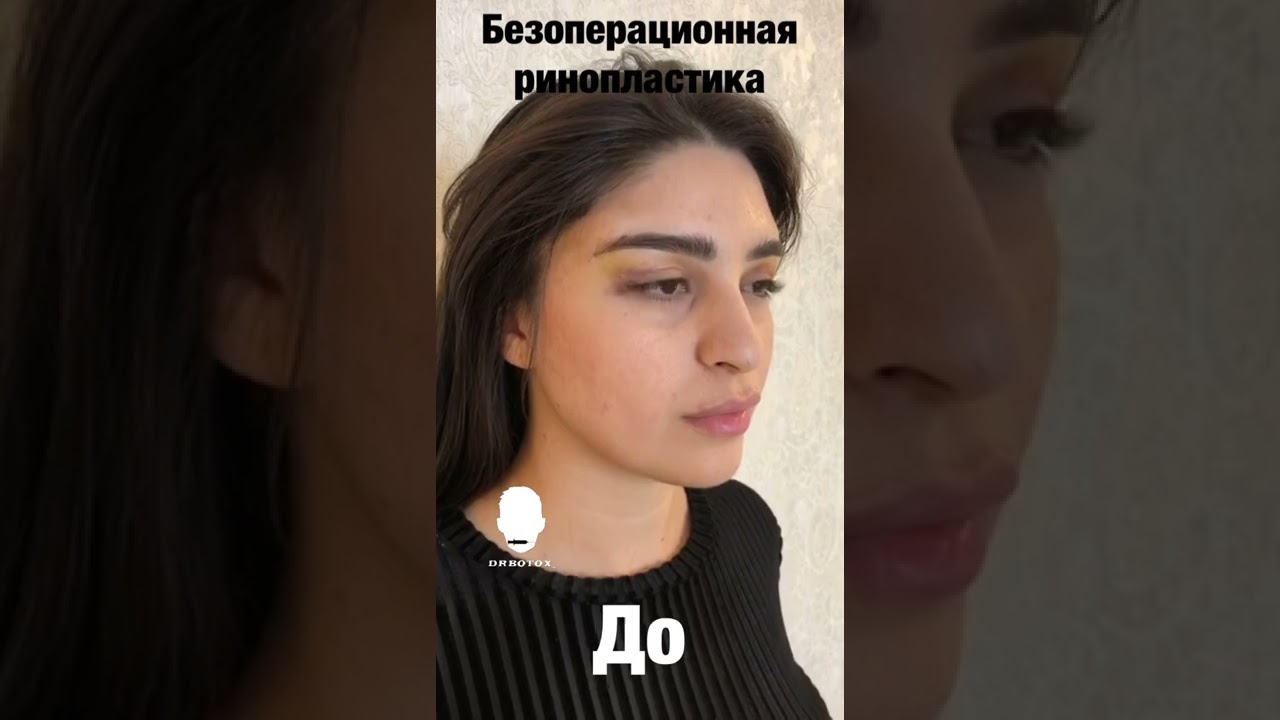Сделали нос без операции.