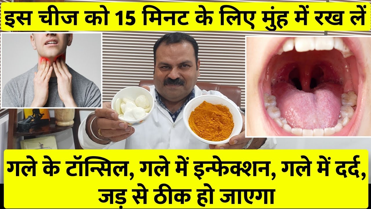 गले के टॉन्सिल,गले में इन्फेक्शन,गले का दर्द जड़ से ठीक इस चीज को 15 मिनट के लिए मुंह में रख लें