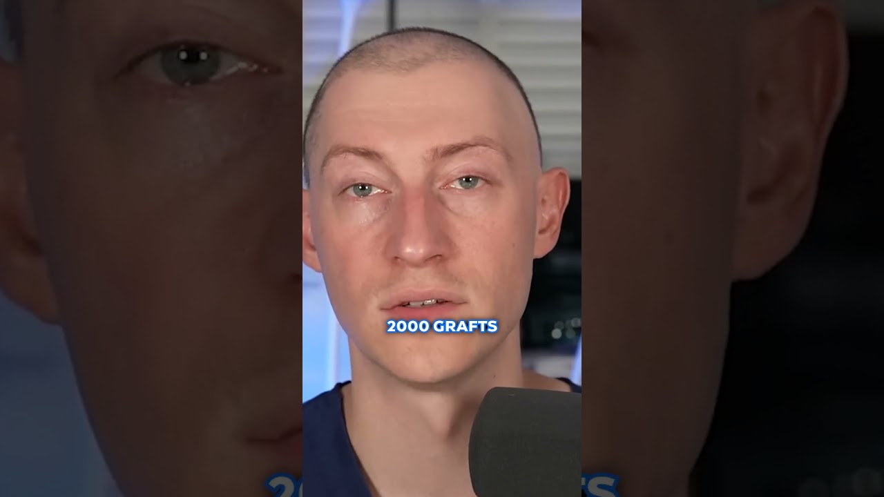 How Many Grafts Will I Need For A Hair Transplant?