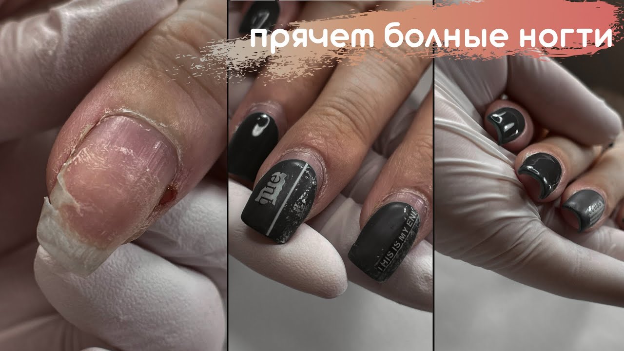 Онихолизис. ТАК ДЕЛАТЬ НЕЛЬЗЯ!!! Перекрываем больные ногти