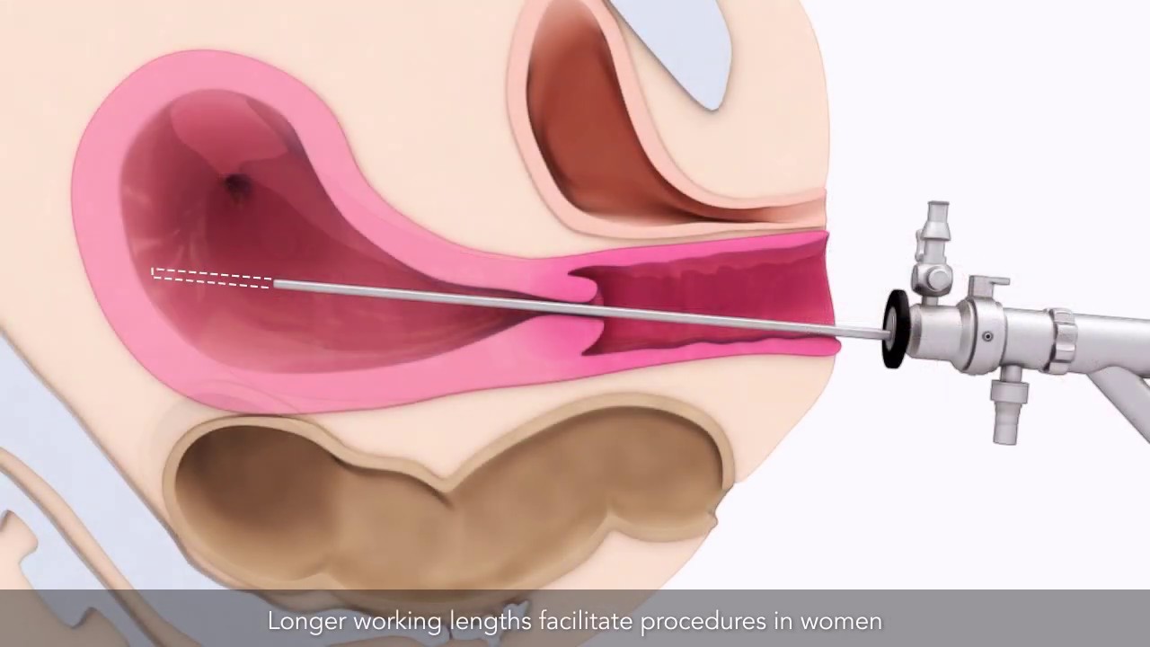 Basics of hysteroscopy | TVASurg
