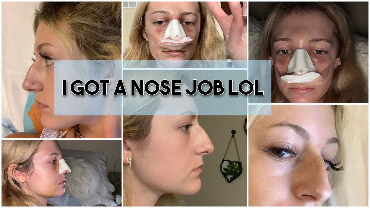 NOSE JOB VLOG | My Rhinoplasty Experience, Recovery + More