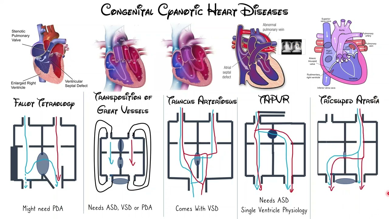 Congenital Heart Diseases: Cyanotic Diseases - TGA and Others (6)