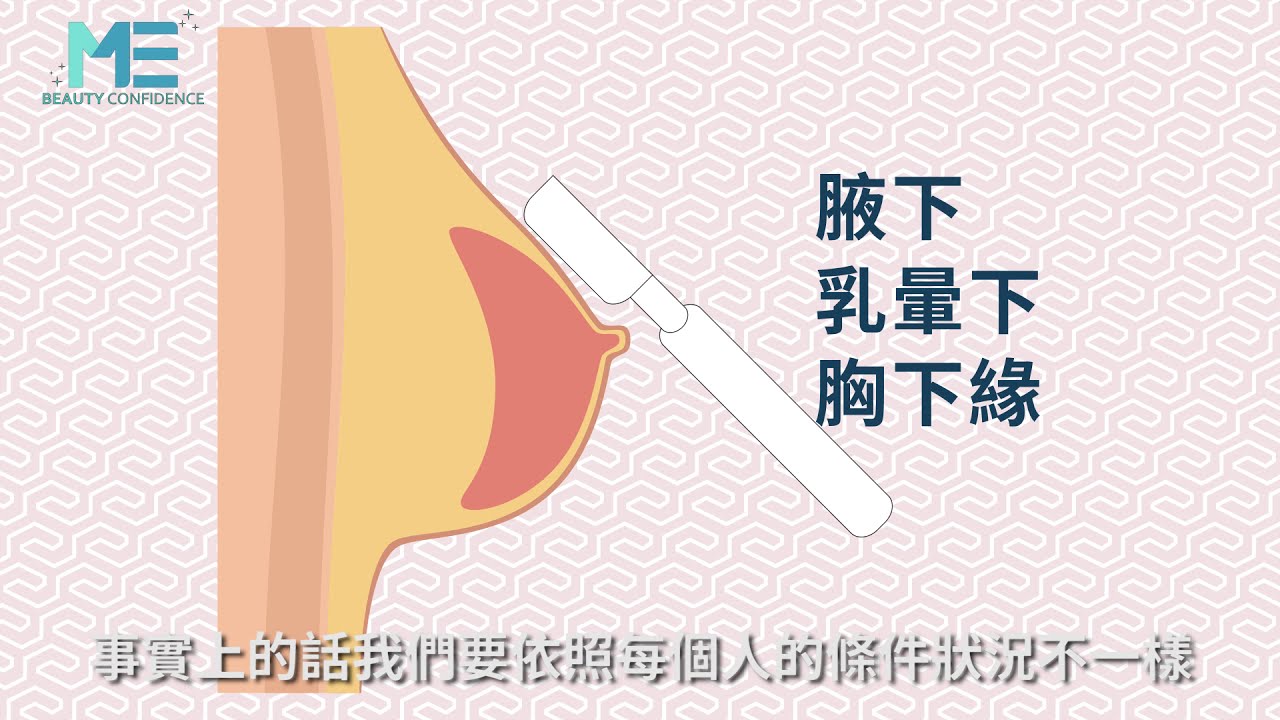 隆乳｜隆乳切口很重要 精準掌控免操心 ft.整型外科王祥亞醫師【ME美醫誌】
