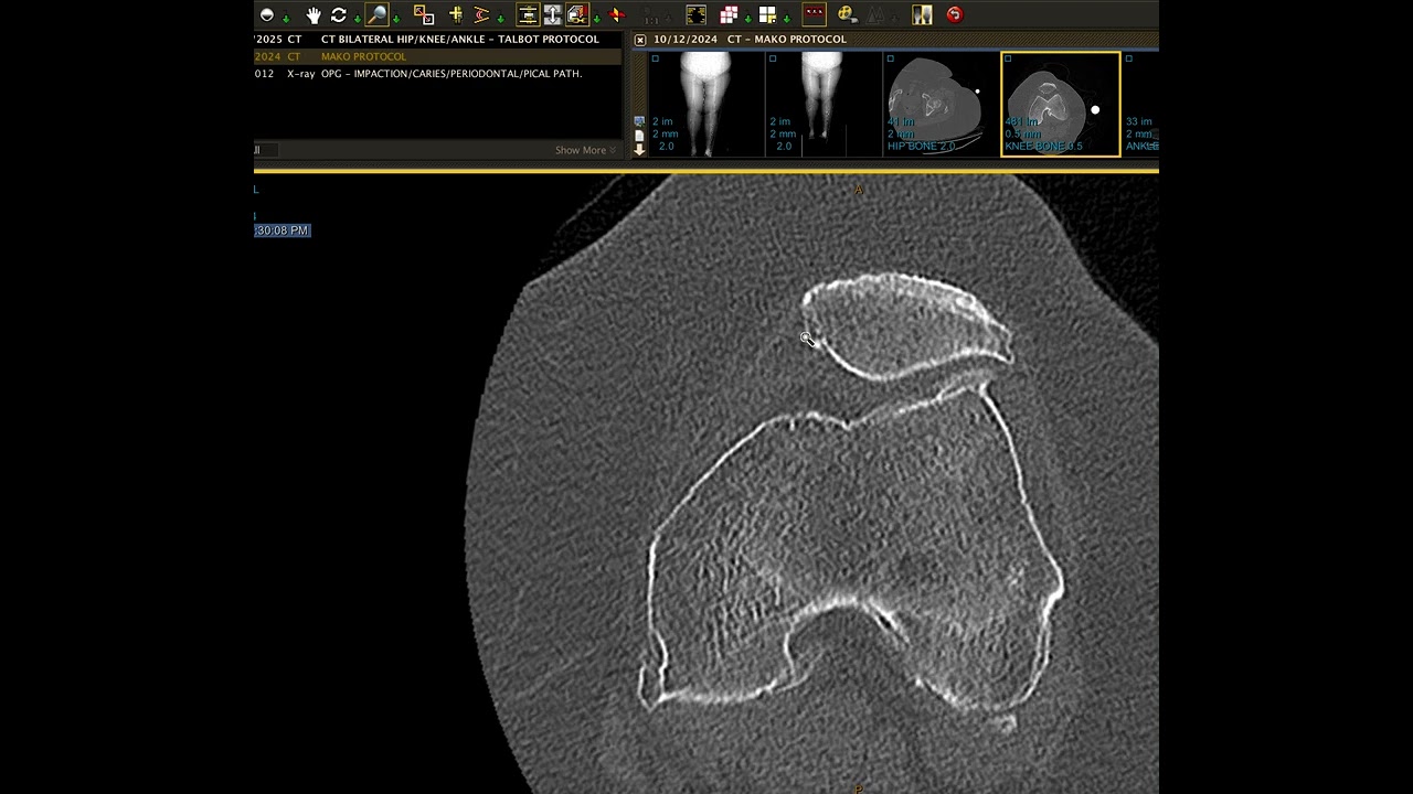 How to measure Quadriceps Tendon Malalignment on CT scans
